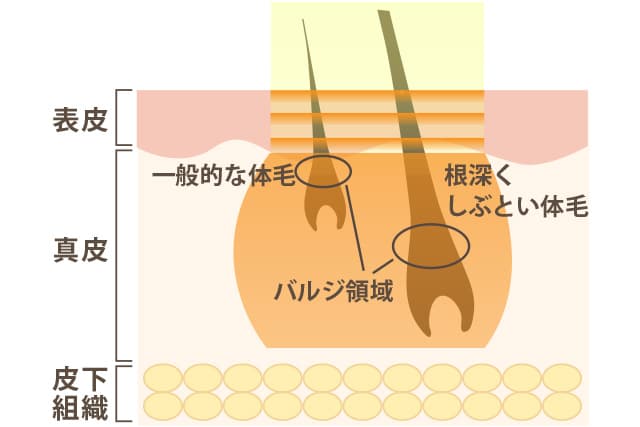 バルジ領域まで熱を届ける脱毛法の説明図